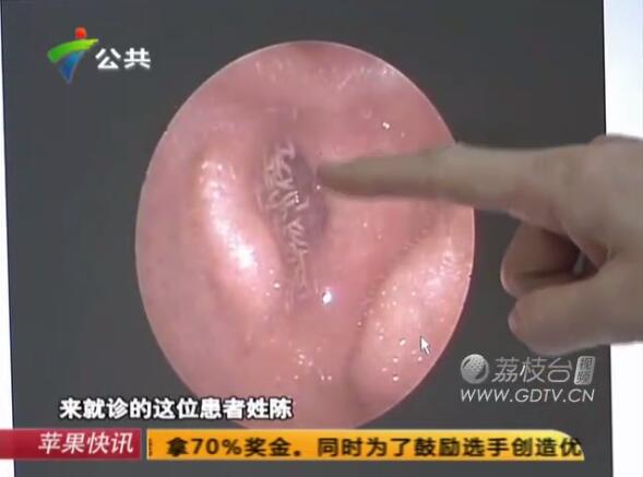 驚恐!男子耳內(nèi)長滿白色爬蟲,撕咬耳道痛不欲生!