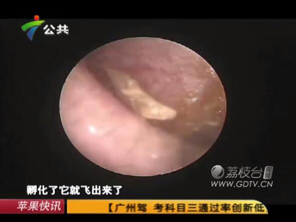 驚恐!男子耳內(nèi)長滿白色爬蟲,撕咬耳道痛不欲生!