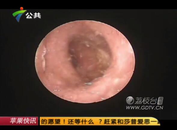 驚恐!男子耳內(nèi)長滿白色爬蟲,撕咬耳道痛不欲生!
