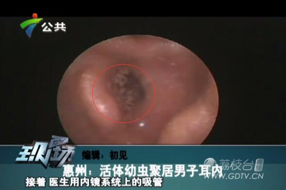 驚恐!男子耳內(nèi)長滿白色爬蟲,撕咬耳道痛不欲生!